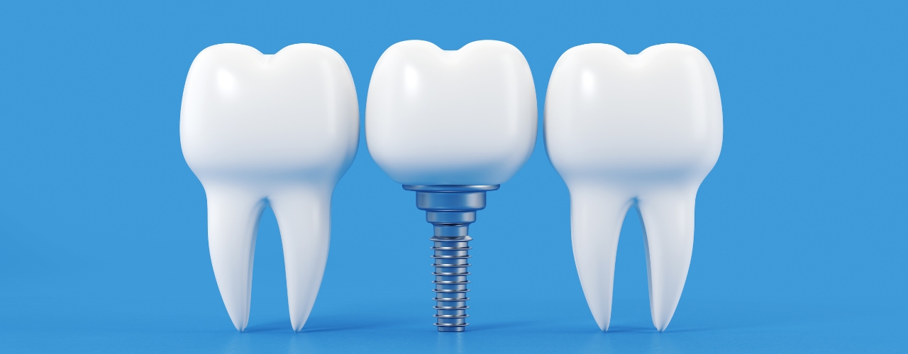 Dental Implants
